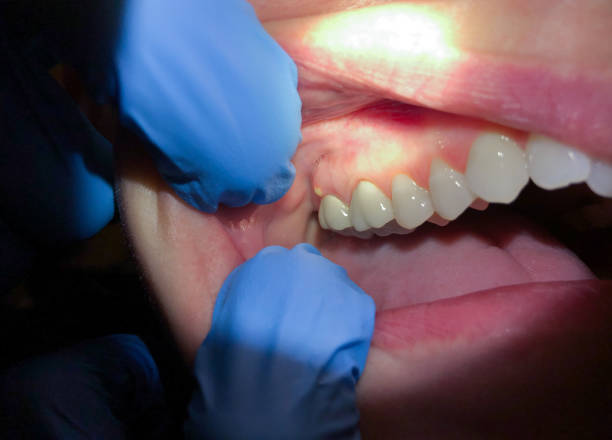 Best Emergency Root Canal Treatment in Hughesville, PA